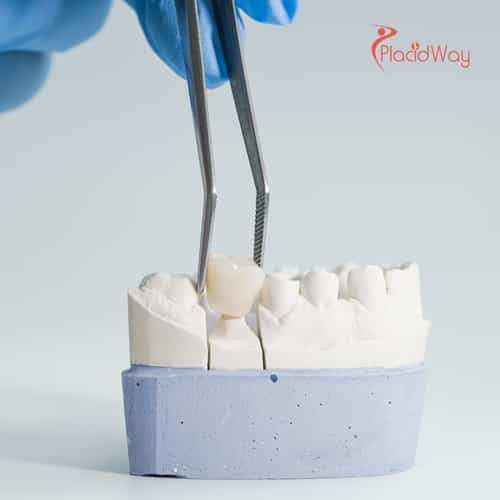 Dental Crown and Bridge Treatment in Mexico for U.S. Patients